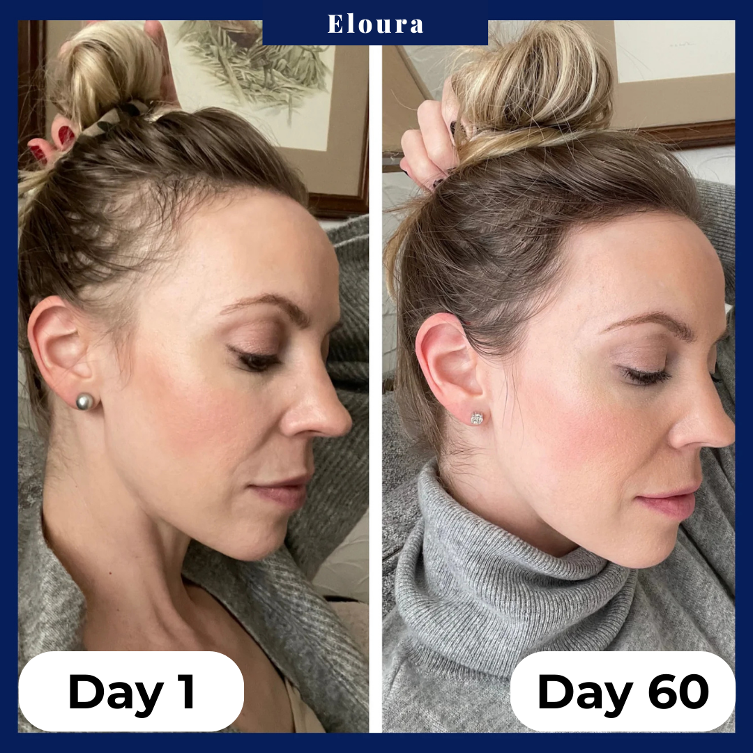 You lost the weight, don't lose your hair. Try Eloura HairRevive™ Roll on System, specifically designed for GLP-1, Mounjaro users.